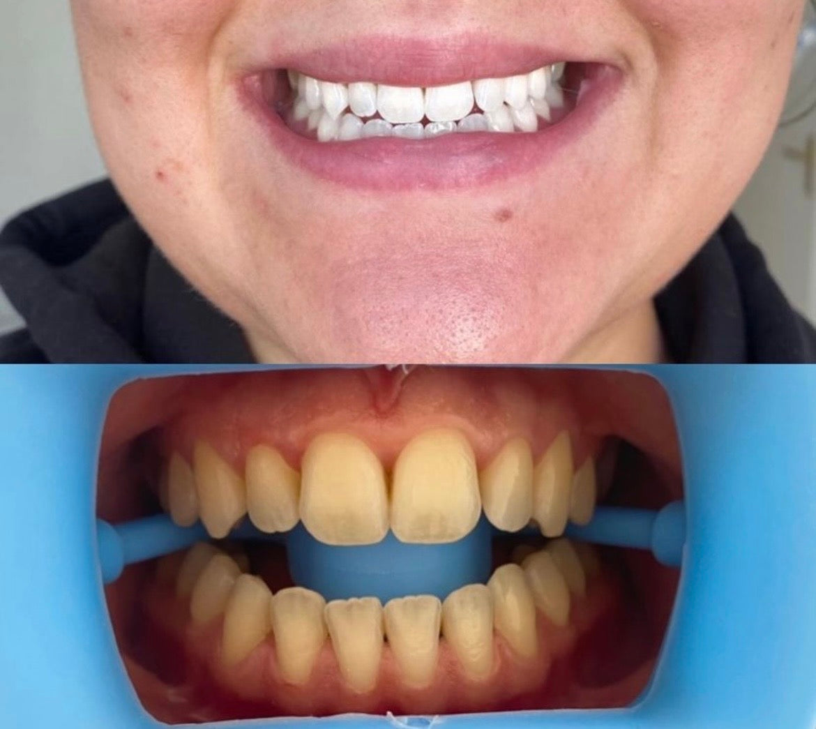 blanchiment dentaire + kit inclus sur place (1 jour)