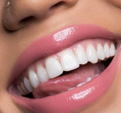 blanchiment dentaire + kit inclus sur place (1 jour)