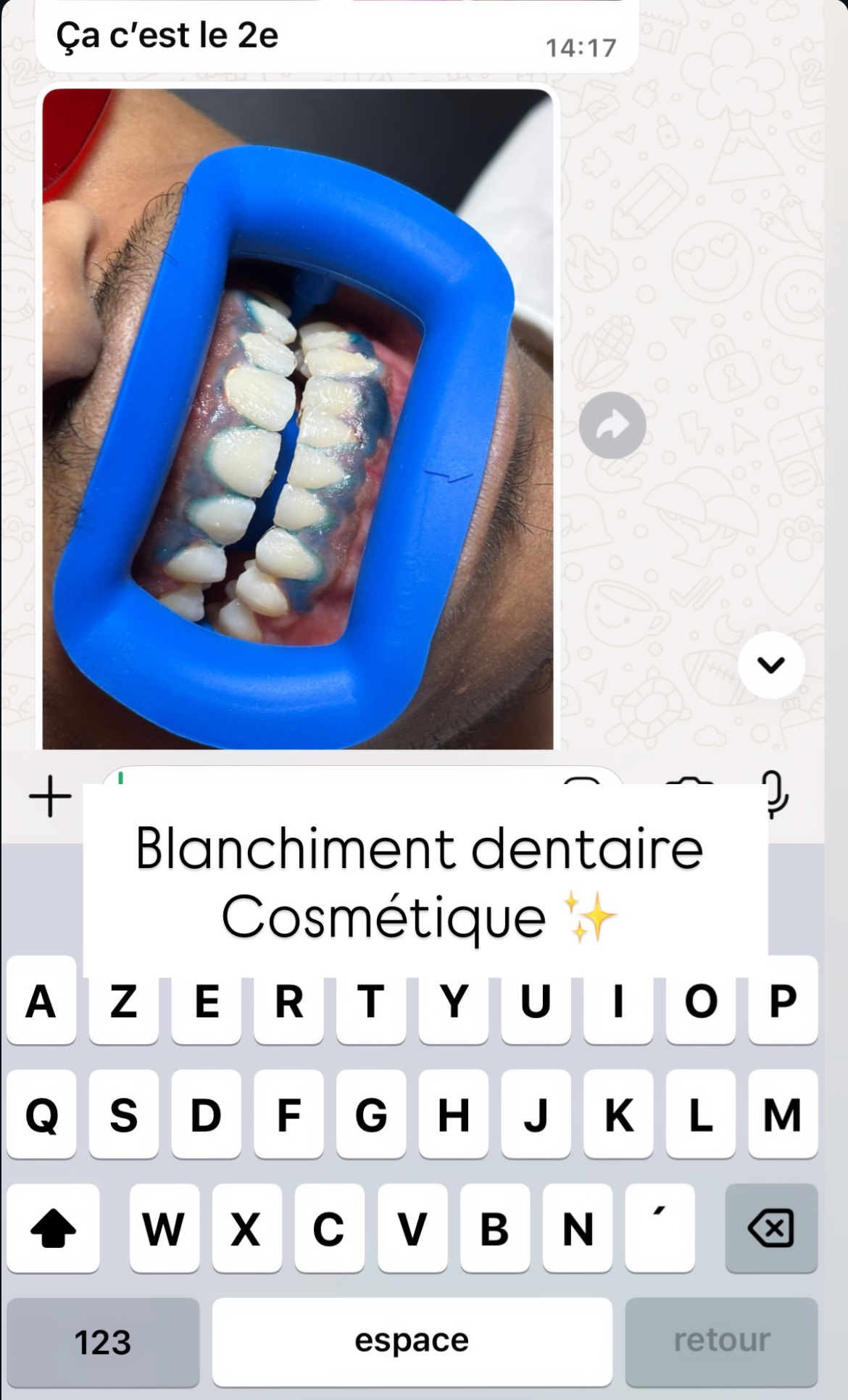 Pack 2 en 1 : blanchiment dentaire et strass dentaire + kit inclus (à distance )