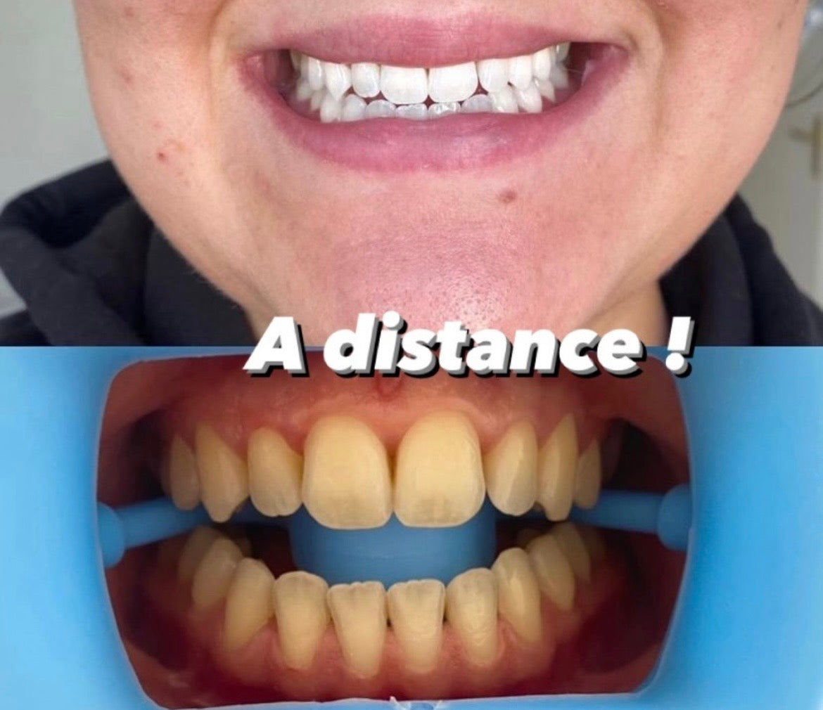 blanchiment dentaire + kit inclus ( à distance)