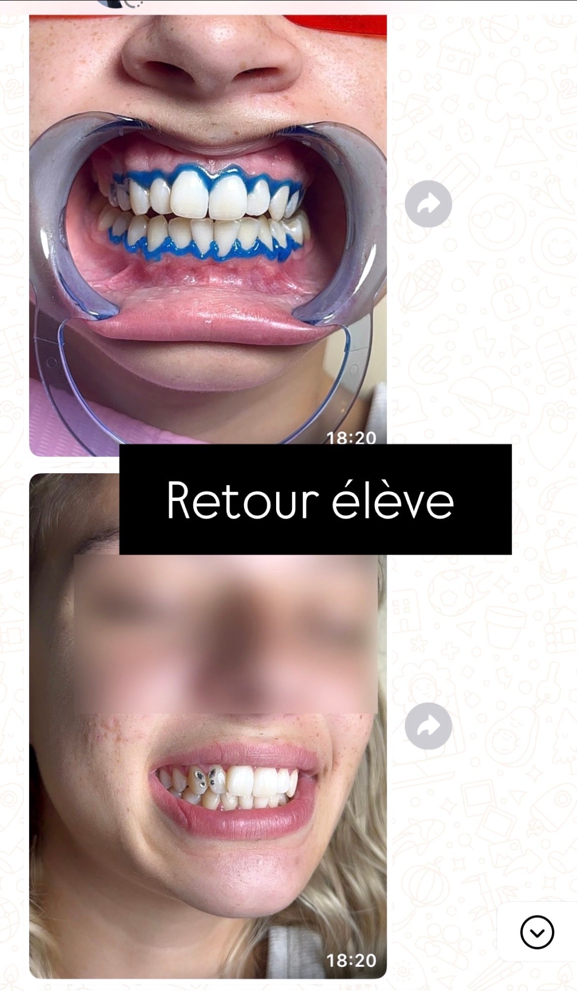 Formule strass dentaire avec kit inclus ( à distance)