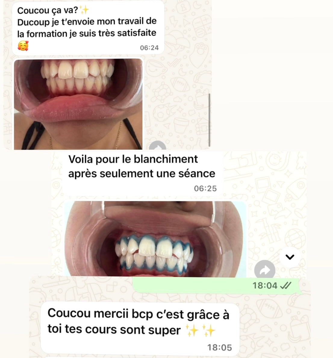 blanchiment dentaire + kit inclus ( à distance)
